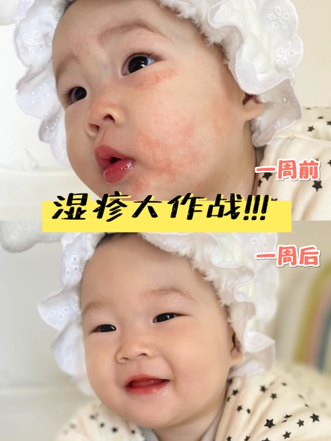 那些求湿疹不用药好的快的姐妹看过来❗️