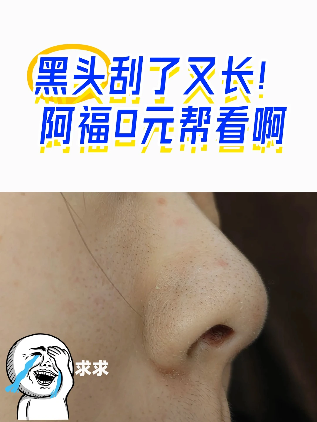 黑头反反复复！问AI能有用吗？🤔