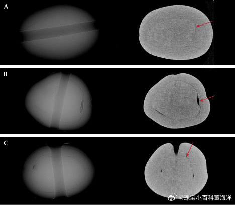 印度老铁的大活。GIA 孟买实验室收到了一条由浅奶油色和奶油色珍珠组成的五排项链，需进行鉴定。这些珍珠的形状从近纽扣形到近椭圆形不等，直径在3.27至4.80毫米之间，整体外观匹配度良好。实时X射线显微放射成像（RTX）显示，大多数珍珠为天然珍珠，呈现出由同心生长弧包围的大小不一的核心结构，然而，依旧有八颗珍珠呈现出可疑的内部结构，部分珍珠的界限模糊不清。由于难以在串珠状态下做出准确鉴定，所以这些珍珠被取下以进行进一步分析。取下的这八颗珍珠重量在0.51至0.68克拉之间，尺寸范围从4.45×4.33×3.53毫米到5.30×4.22×3.98毫米不等。能量色散X射线荧光光谱分析显示未检出锰元素，锶含量在981至1270ppm之间，表明其生长环境为海水。然而，在 X 射线照射下，部分珍珠呈现出极微弱的黄绿色荧光，且钻孔处的荧光反应较强。尽管海水珍珠通常对X射线荧光呈惰性，但含有淡水贝壳核的海水有核养殖珍珠往往会呈现出弱至中等强度的黄绿色荧光反应。这些海水珍珠所表现出的微弱荧光，结合...