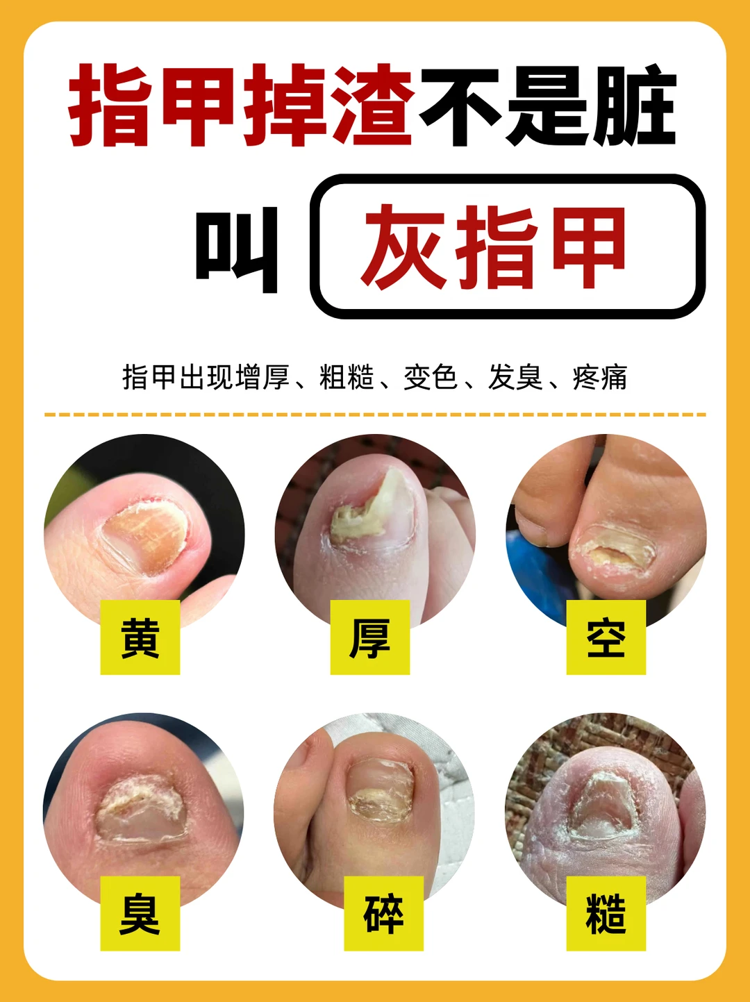 指甲掉渣，不是脏！而是灰指甲