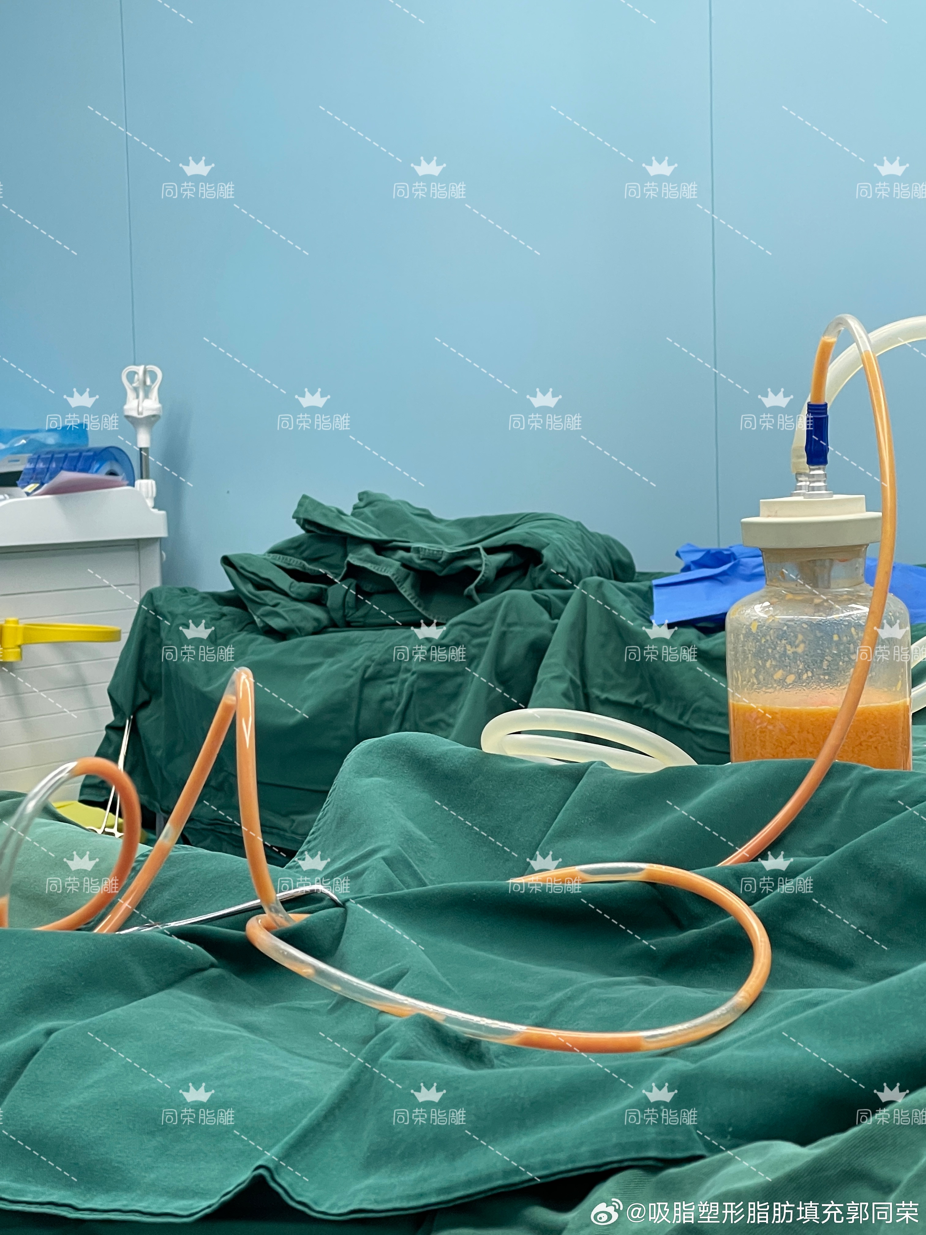 【同荣脂雕多部位吸填结合全程几近无血】  为什么同荣脂雕能做到大面积...