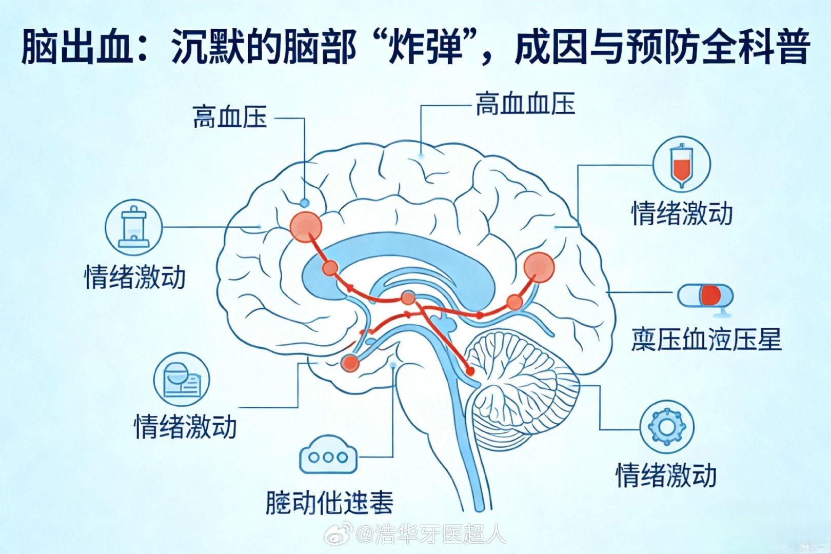 #敬一丹去世##急性脑出血#
脑出血（Intracerebral Hemorrhage，ICH），俗称“脑溢血”，是指非外伤性脑实质内血管破裂，导致血液在脑组织内聚集的急性脑血管疾病。它是“脑卒中”（中风）的一种，具有发病急、进展快、致残率和致死率极高的特点。

一、 脑出血的成因
1.高血压（首要诱因）：长期高血压会导致脑内小血管硬化、变脆，当血压骤然升高（如情绪激动、用力、熬夜、寒冷刺激）时，脆弱的血管极易破裂出血。

2.脑血管病变：如脑动脉瘤、脑血管畸形、脑动脉粥样硬化等，在血压波动时易引发出血。

3.其他诱因：长期熬夜、过度劳累、酗酒、吸烟、情绪剧烈波动、用力排便（便秘）等，均会加重血管负担，诱发脑出血。

二、 脑出血的预防
脑出血大部分可防，预防的核心在于“管控基础病”和“改善生活方式”：

1. 严控基础病（核心）
· 控制血压：高血压是脑出血的最主要诱因。需遵医嘱规律、按时服用降压药，不可擅自停药或减药；定期监测血压，避免血压骤升骤降。

· 控制血糖与血脂：积...