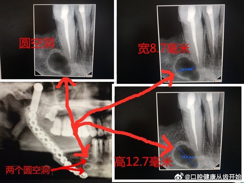 #00后女生咳嗽腰疼一查已是肺癌晚期#广东省深圳市北京大学深圳医院做的5次手术，第1次至第3次手术做根管治疗和牙下面两个圆空洞位置已经康复没有圆空洞，第4次手术换的腓骨和加的长弯型的台板，过了一段时间第1次至第3次手术位置病情复发有了圆空洞至今未愈，请评论手术和台板固定位置! ​