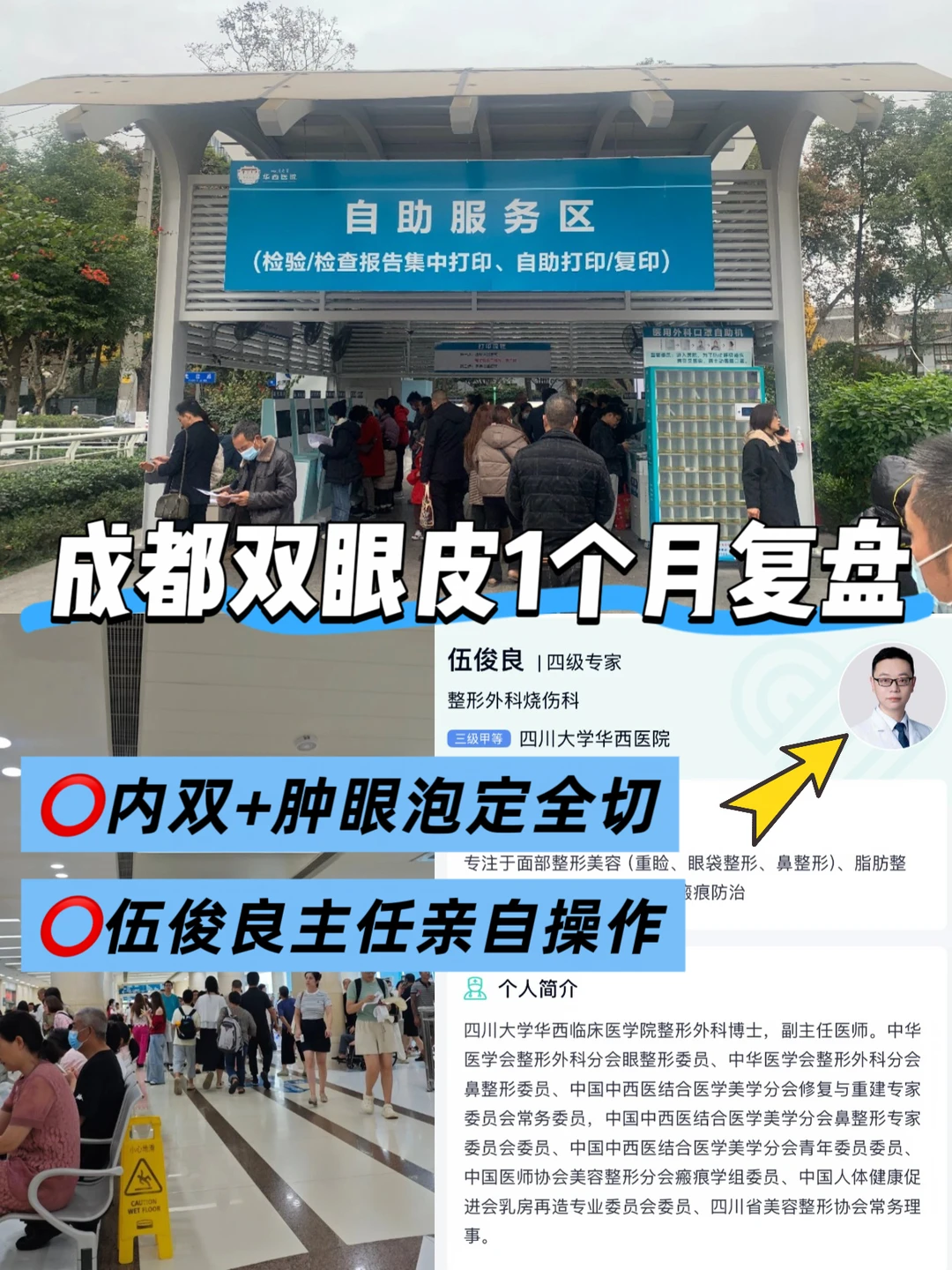 成都双眼皮，华西主任1个月后续复盘