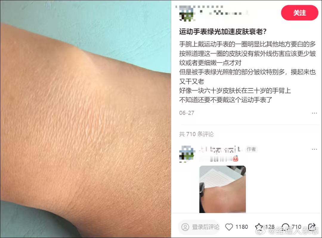 【#第一批戴运动手环的受害者出现了##戴运动手环皮肤损伤原因#】
近日，不少网友反映长期佩戴运动手环、智能手表后，手腕一圈皮肤发白、发干粗糙，部分甚至发硬增厚。医学分析指出，绿光光老化、漏电、低温烫伤等常见猜测缺乏可靠医学支撑，主要原因是过敏性接触性皮炎与刺激性接触性皮炎两类皮肤问题 ​