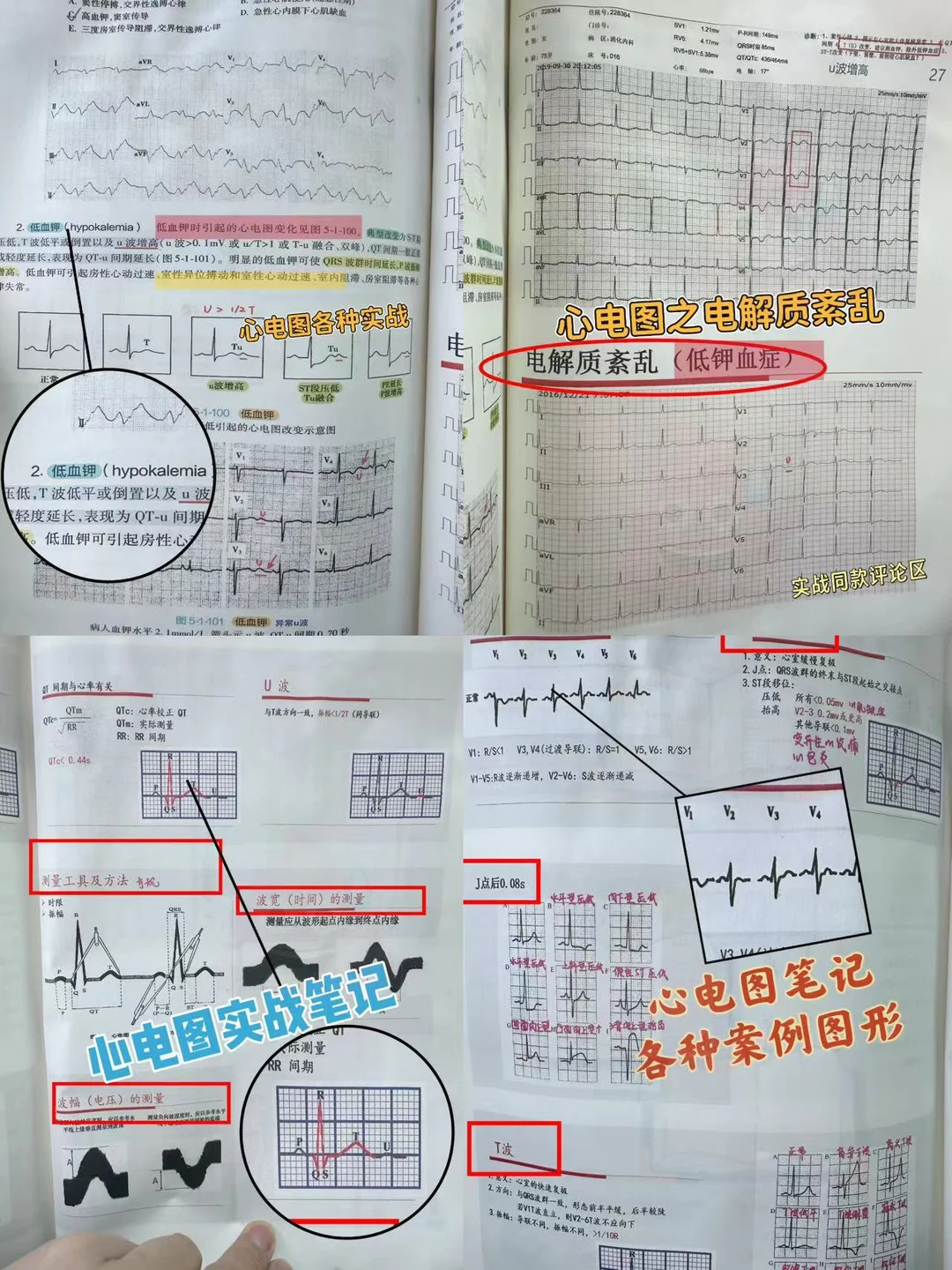 心电图干货实战