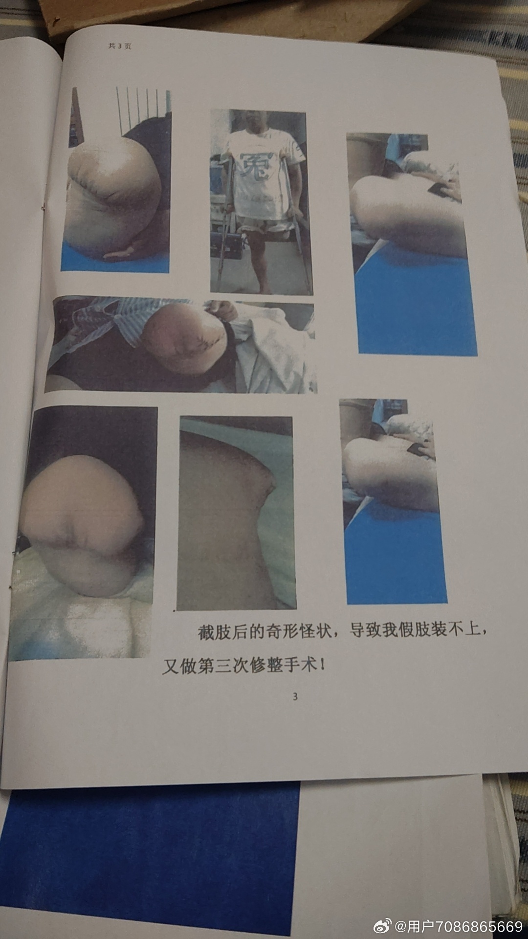 血泪控诉！（发布于2026年8月26日）河科大一附院（洛阳老三院）骨外科医生：林力：给我做腘窝脂肪瘤小手术，索要红包没达滿意，手术就不认真负责，误将我左下肢神经切断，下肢失去知觉、瘫痪！导致被迫截肢！手术前，我每天打乒乓球俩小时，生活走路运动正常。术前《患肢无压疼，活动度可，周围皮肤颜 ​